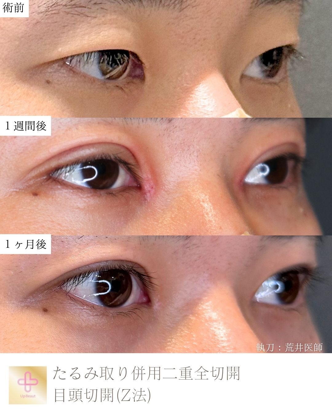 たるみ取り併用全切開二重術、目頭切開(Z法)