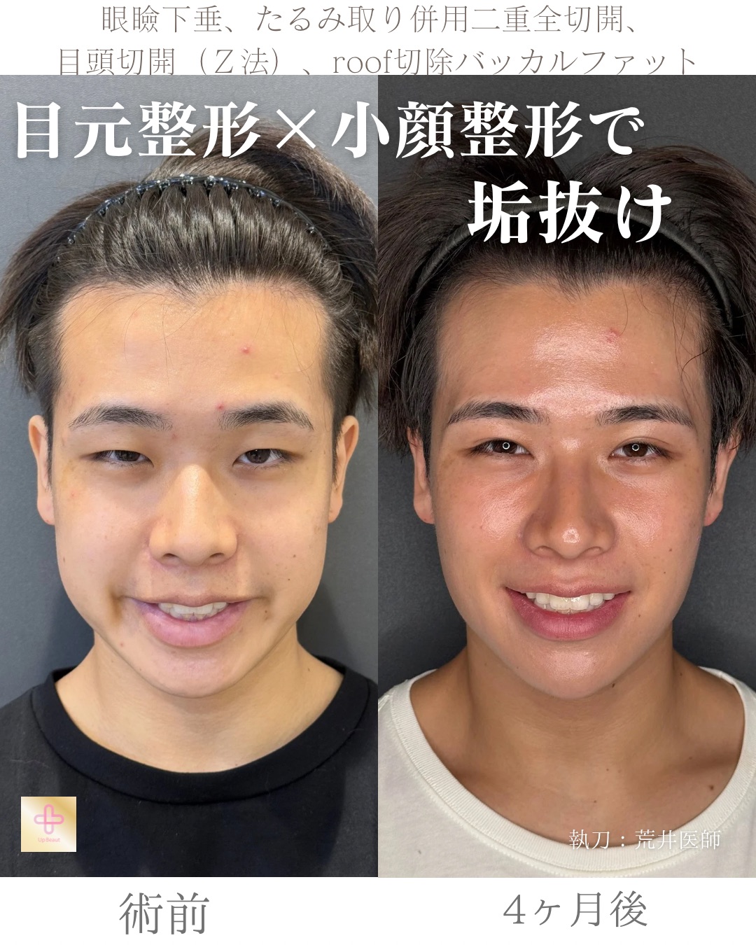 二重全切開たるみ取り併用、ROOF切除、眼瞼下垂、目頭切開(Z法)、バッカルファット、顎ヒアルロン酸1cc