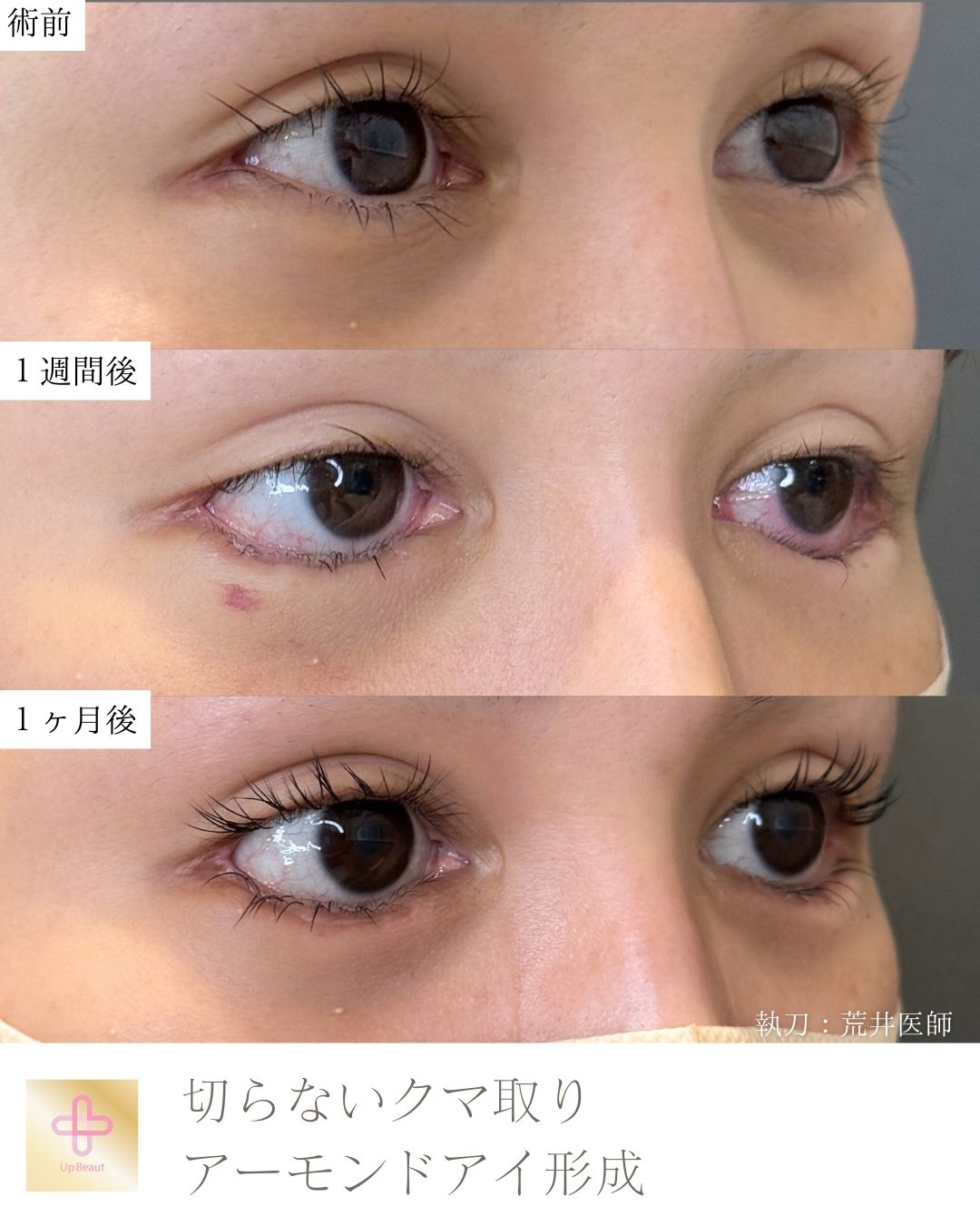 アーモンドアイ形成、切らないクマ取り