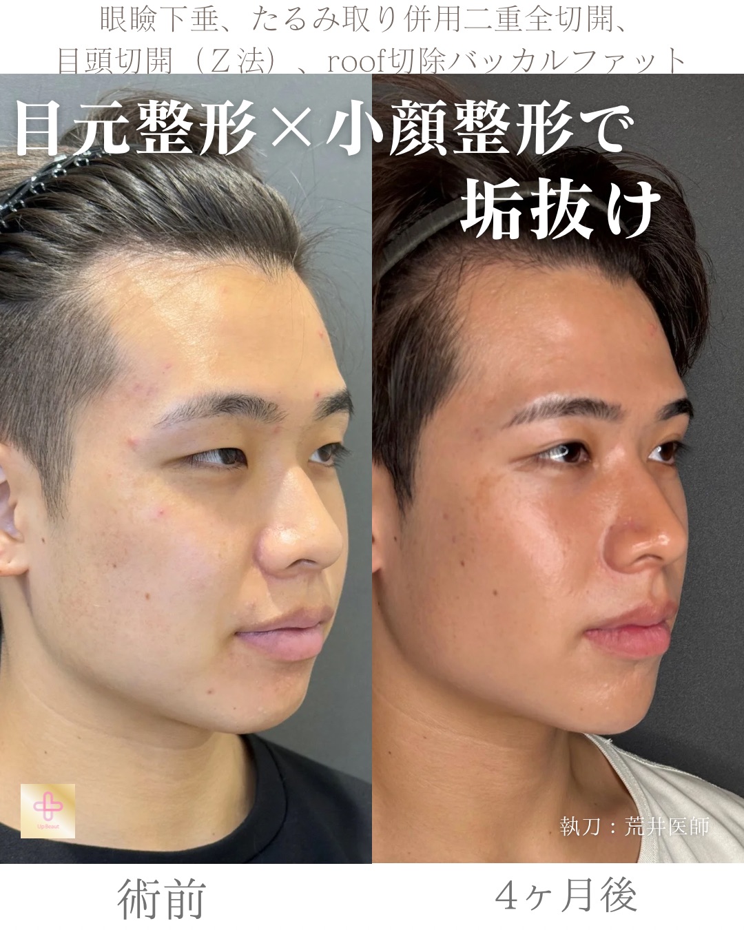 二重全切開たるみ取り併用、ROOF切除、眼瞼下垂、目頭切開(Z法)、バッカルファット、顎ヒアルロン酸1cc