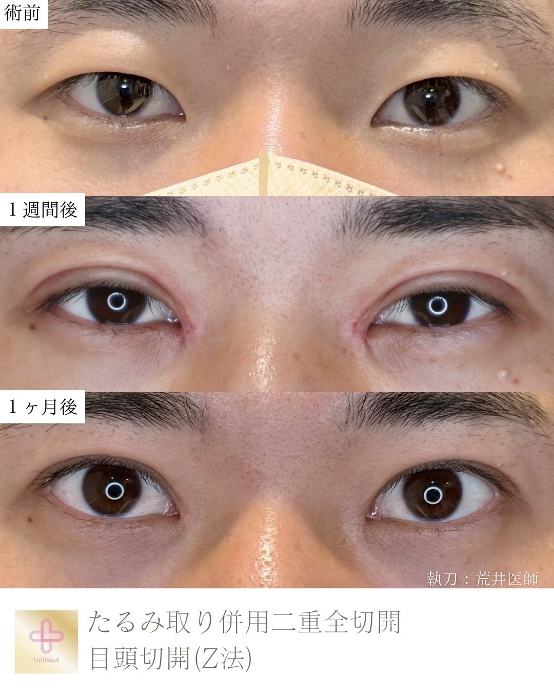 たるみ取り併用全切開二重術、目頭切開(Z法)