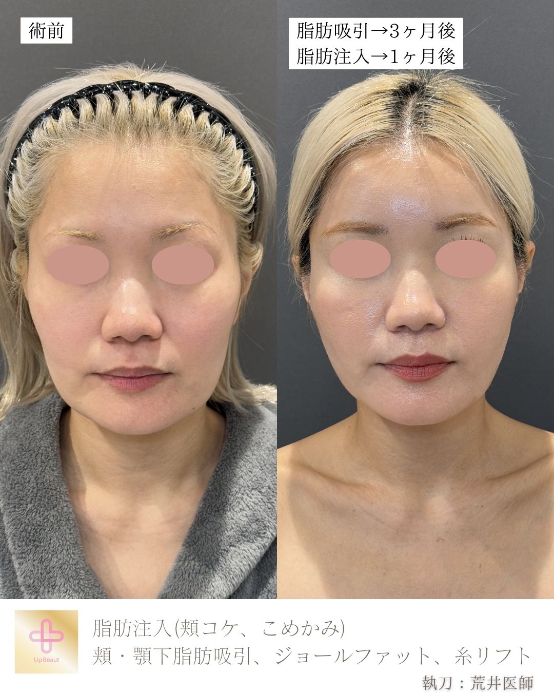 脂肪注入(頬コケ、こめかみ)、頬・顎下脂肪吸引、ジョールファット、糸リフト