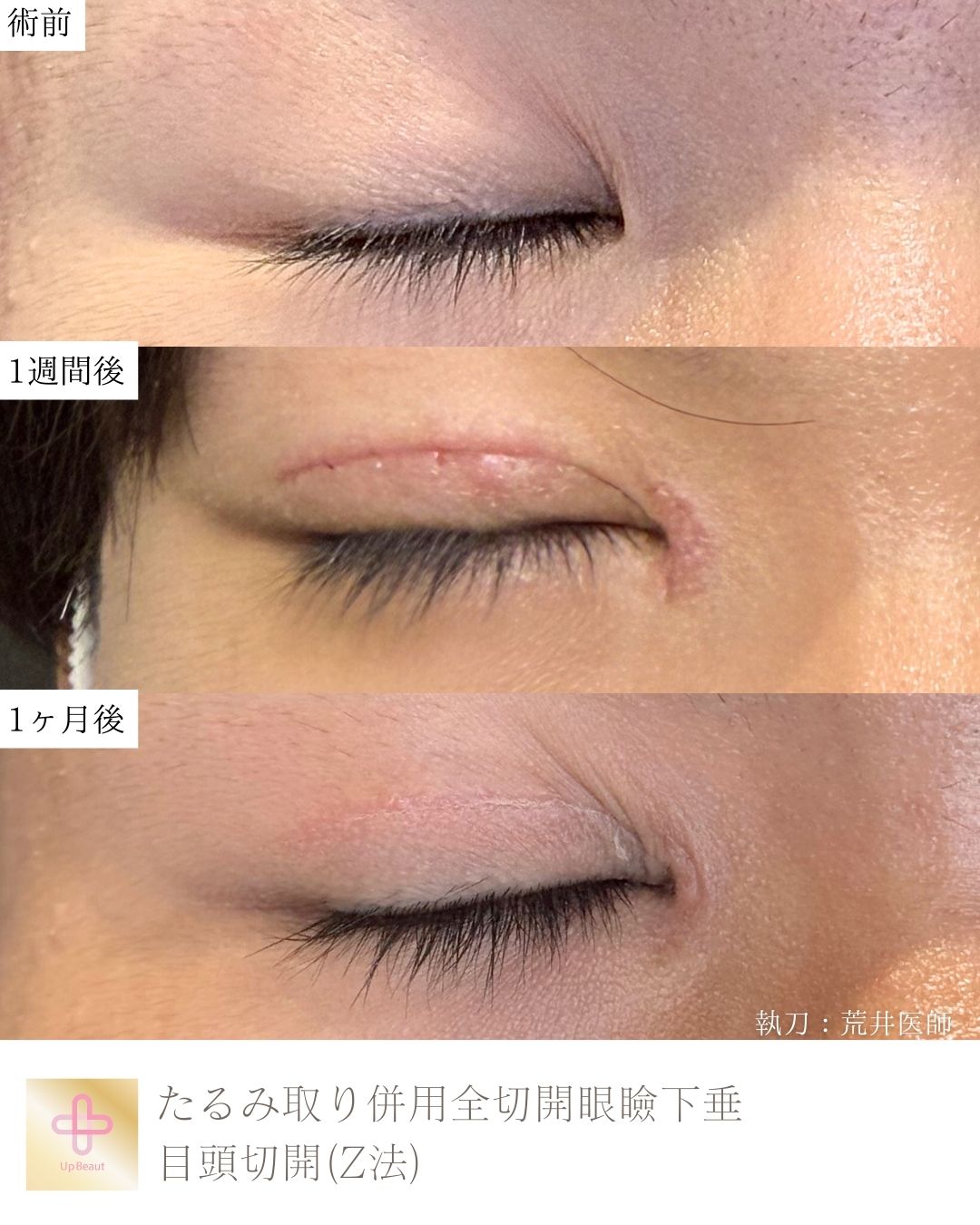 たるみ取り併用全切開二重術、目頭切開(Z法)