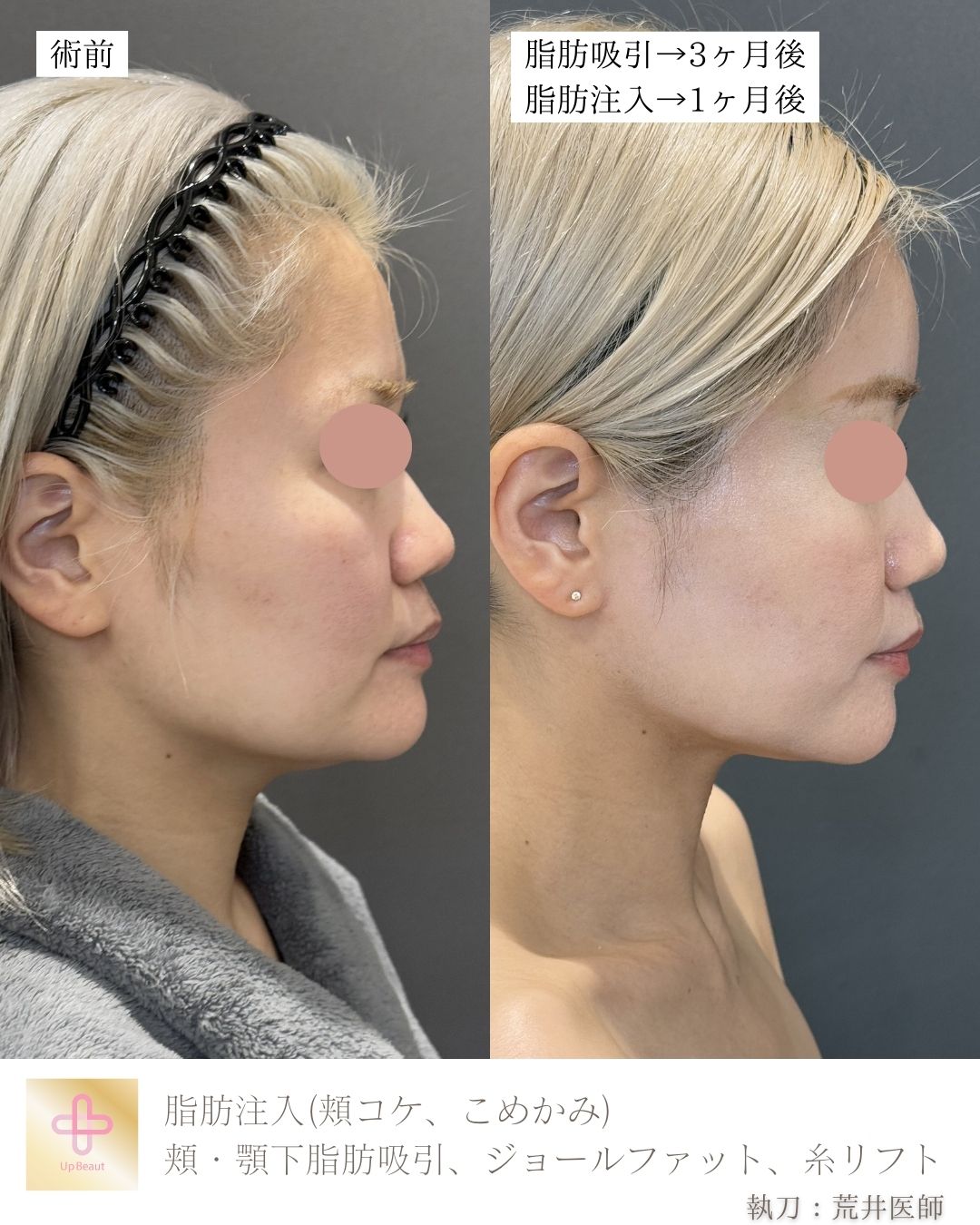 脂肪注入(頬コケ、こめかみ)、頬・顎下脂肪吸引、ジョールファット、糸リフト