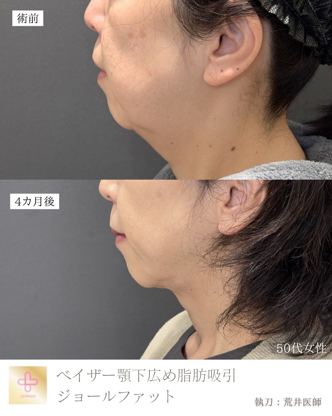顎下広め脂肪吸引、ジョールファット