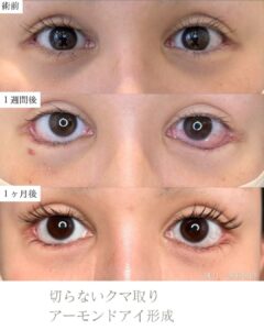 アーモンドアイ形成