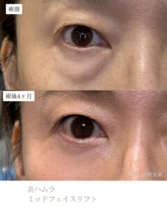 表ハムラ