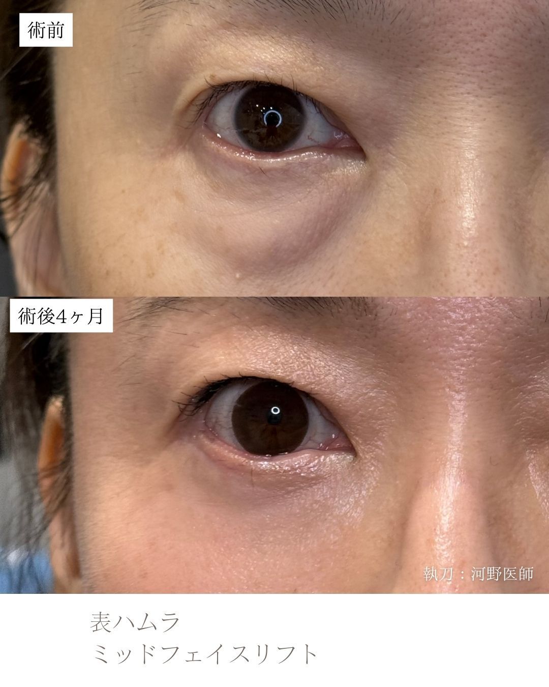 表ハムラ