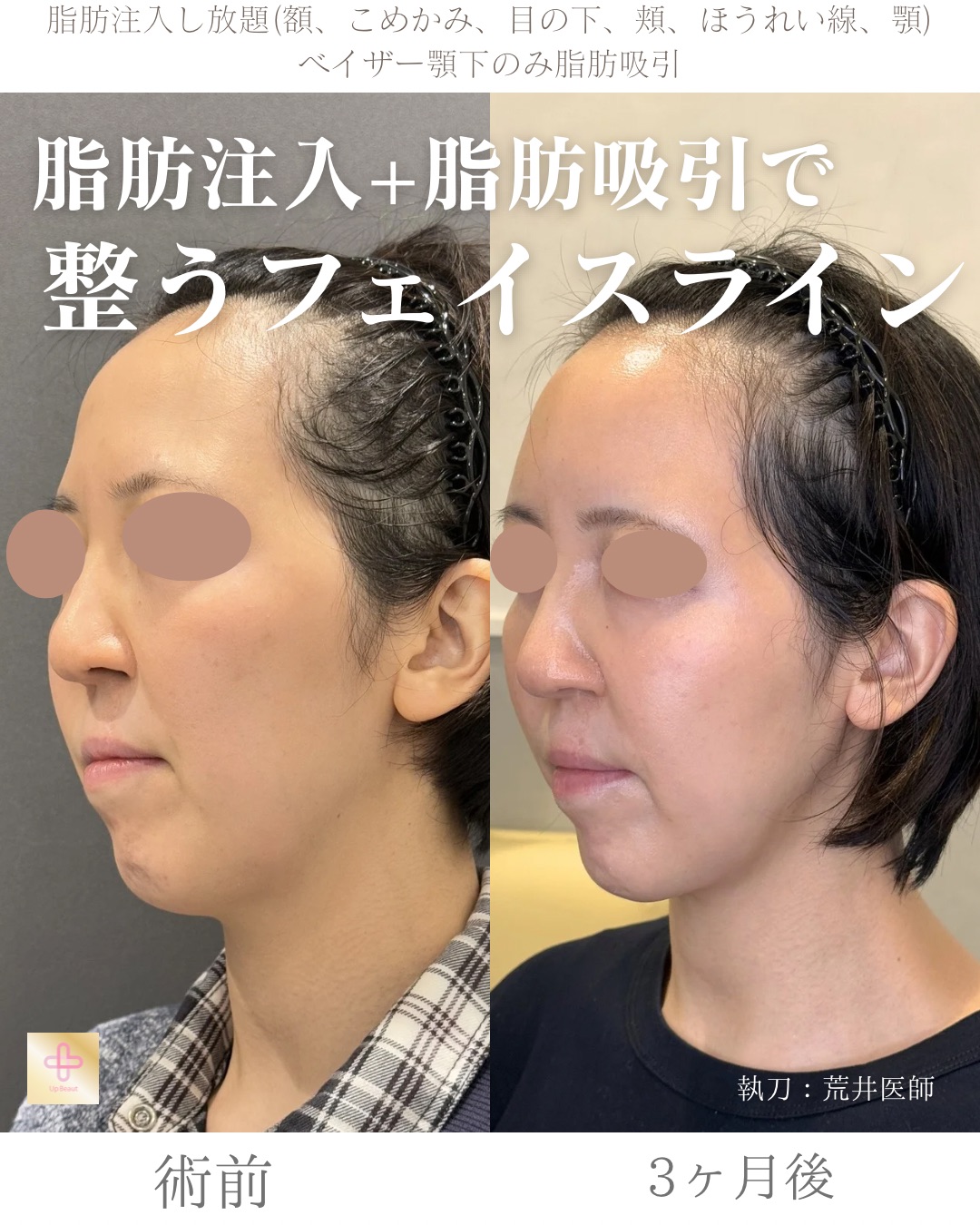 脂肪注入し放題、顎下脂肪吸引