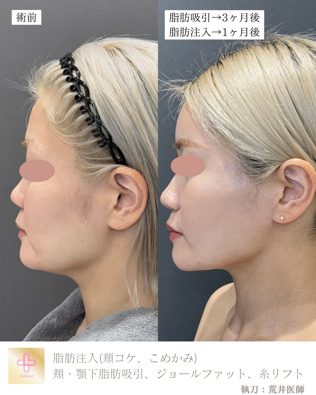 脂肪注入(頬コケ、こめかみ)、頬・顎下脂肪吸引、ジョールファット、糸リフト