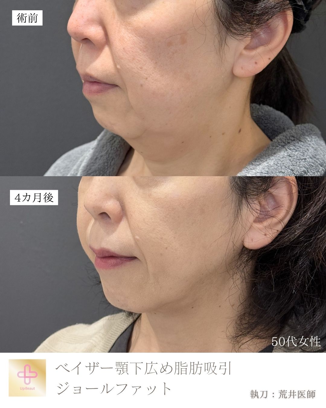 顎下広め脂肪吸引、ジョールファット