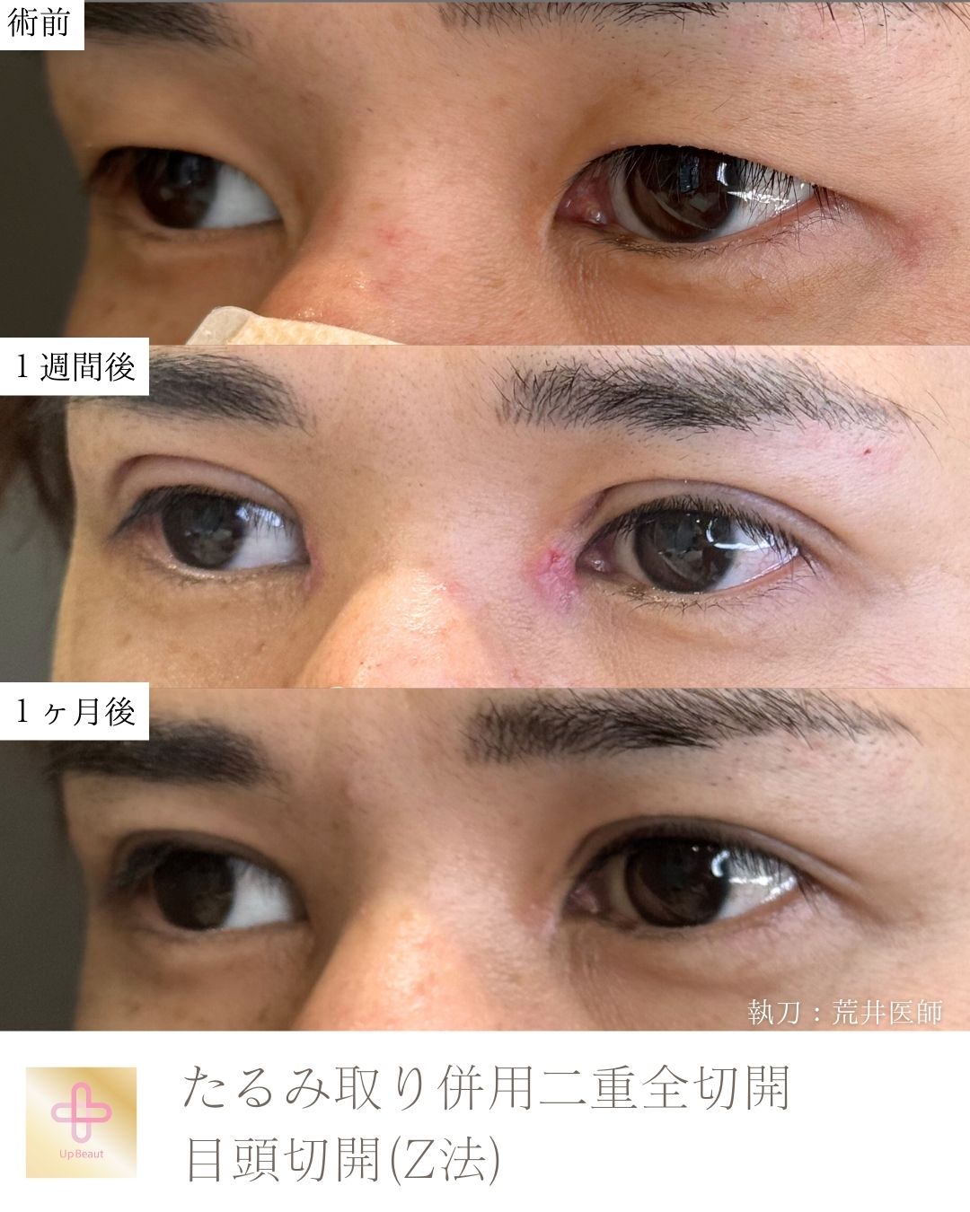 たるみ取り併用二重全切開、目頭切開 (Z法)