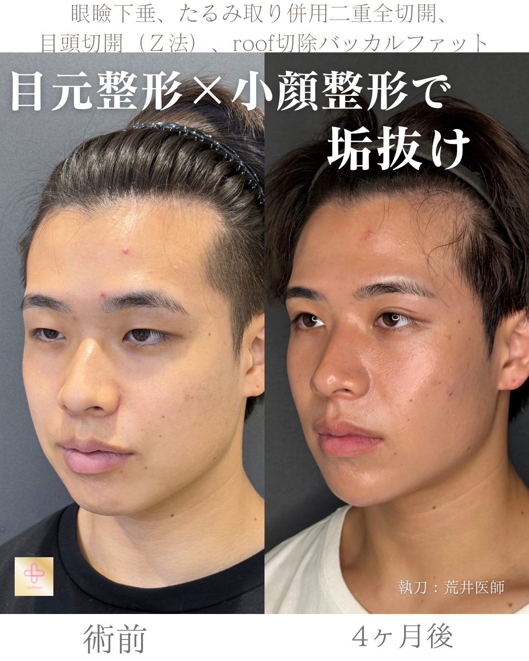 二重全切開たるみ取り併用、ROOF切除、眼瞼下垂、目頭切開(Z法)、バッカルファット、顎ヒアルロン酸1cc