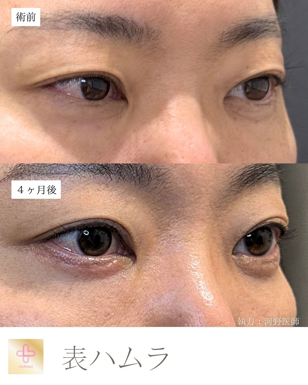 表ハムラ法
