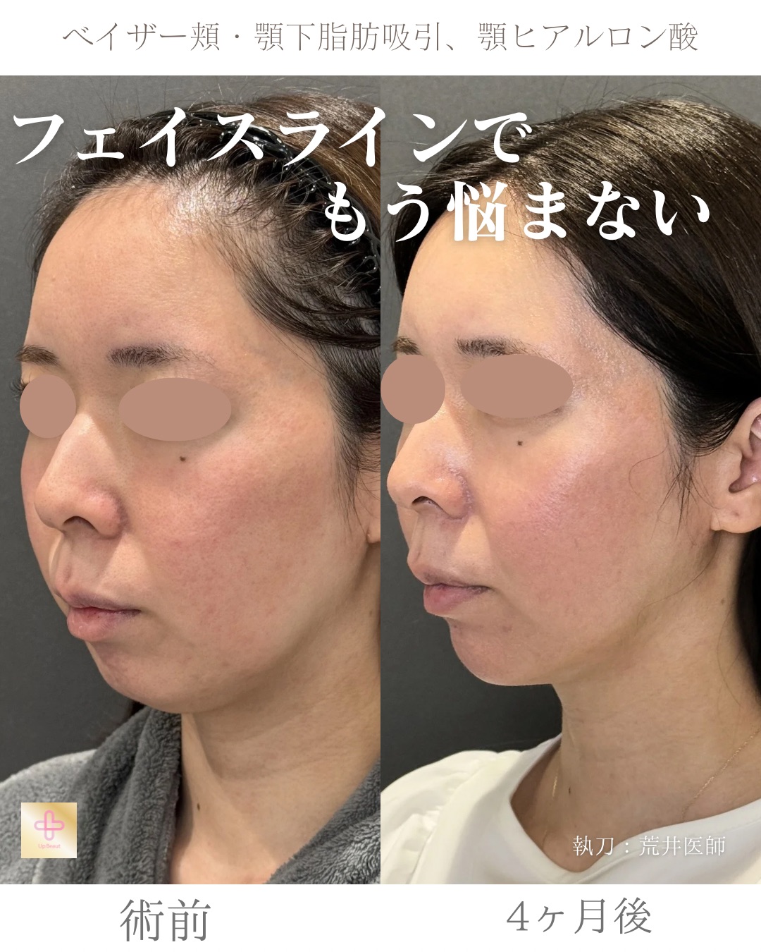 小顔脂肪吸引、顎ヒアルロン酸