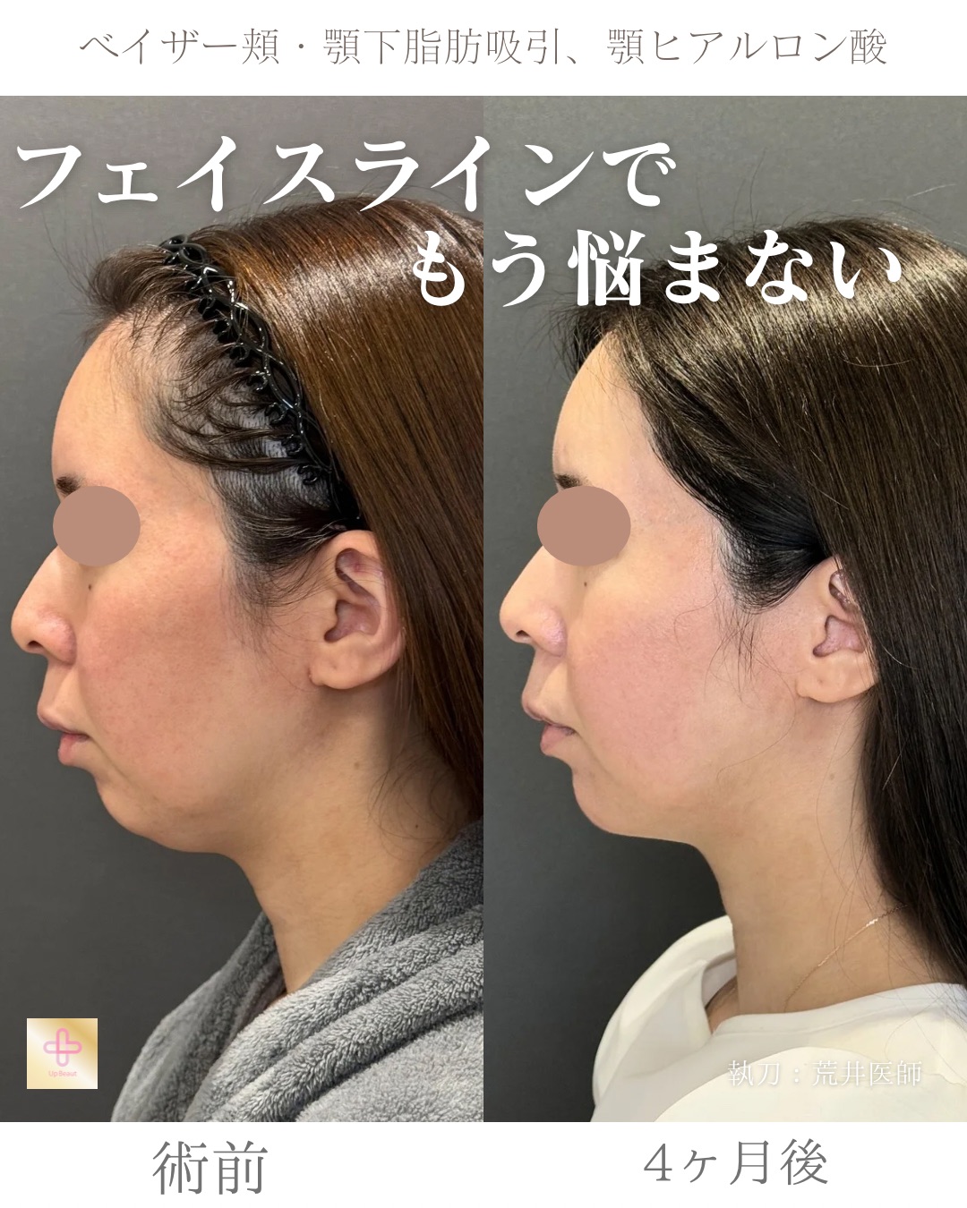 小顔脂肪吸引、顎ヒアルロン酸