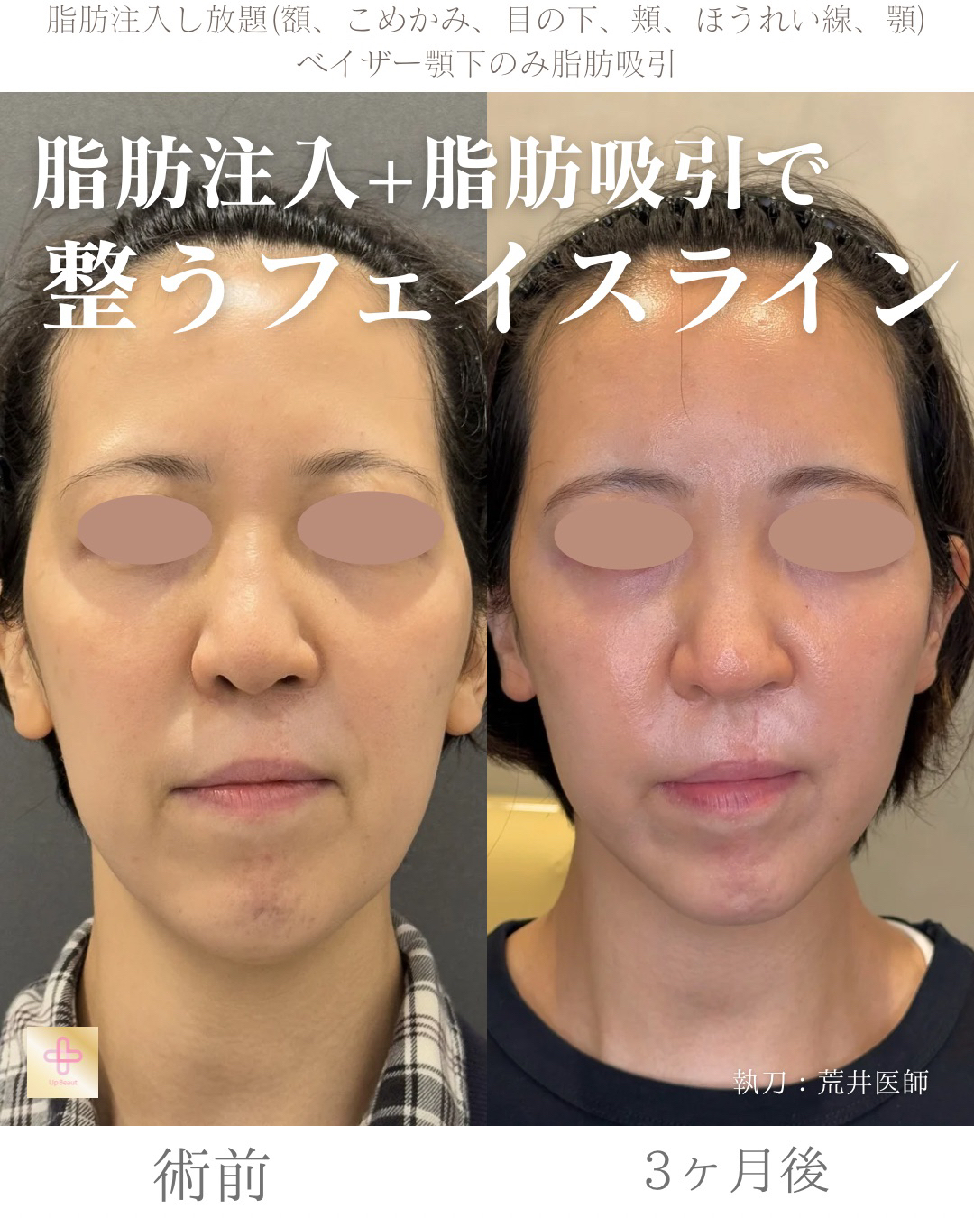 脂肪注入し放題、顎下脂肪吸引