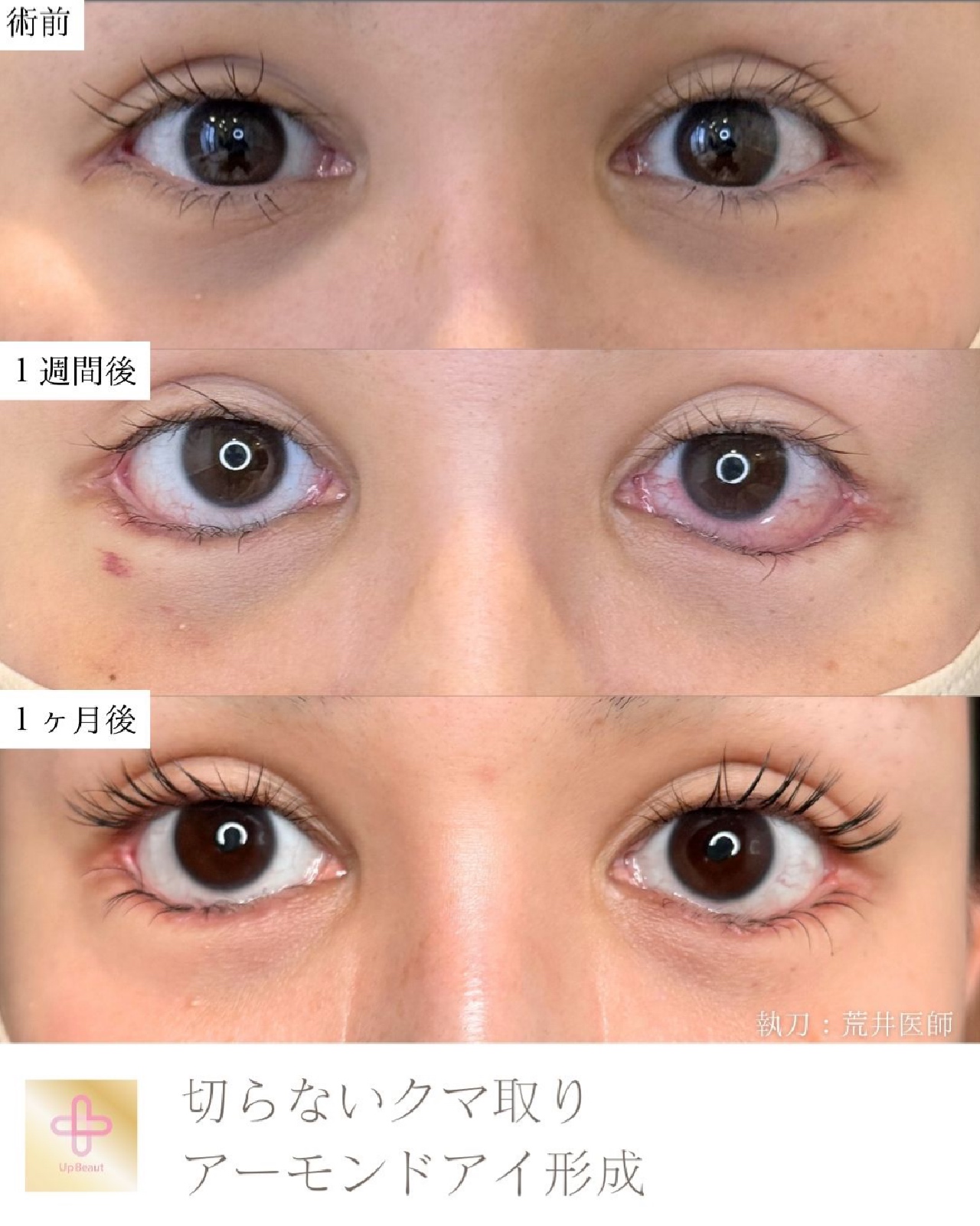 アーモンドアイ形成、切らないクマ取り