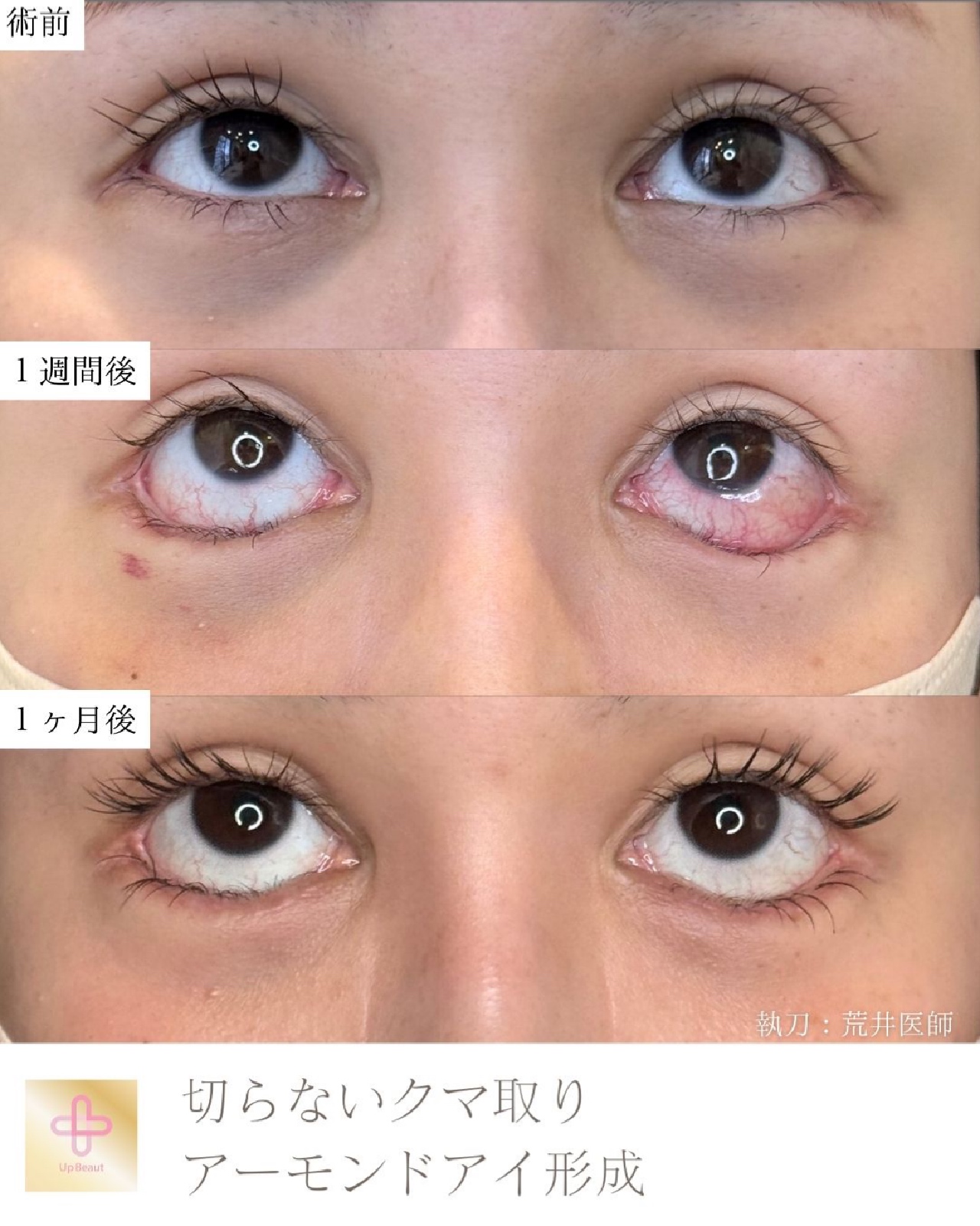 アーモンドアイ形成、切らないクマ取り