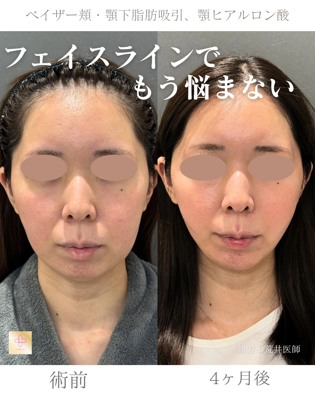 小顔脂肪吸引、顎ヒアルロン酸