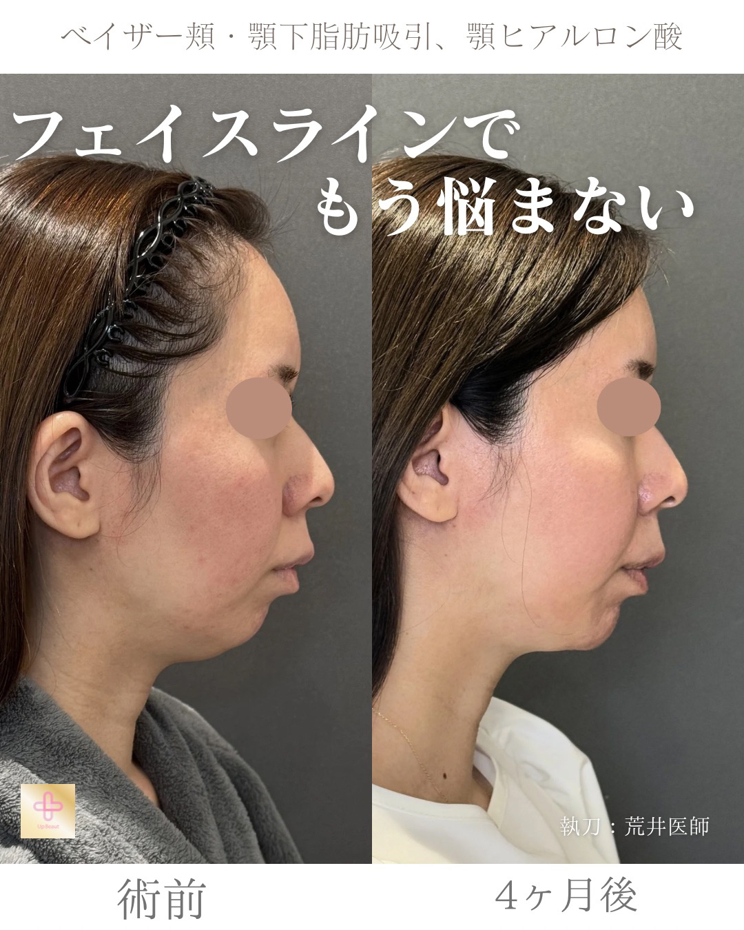 小顔脂肪吸引、顎ヒアルロン酸