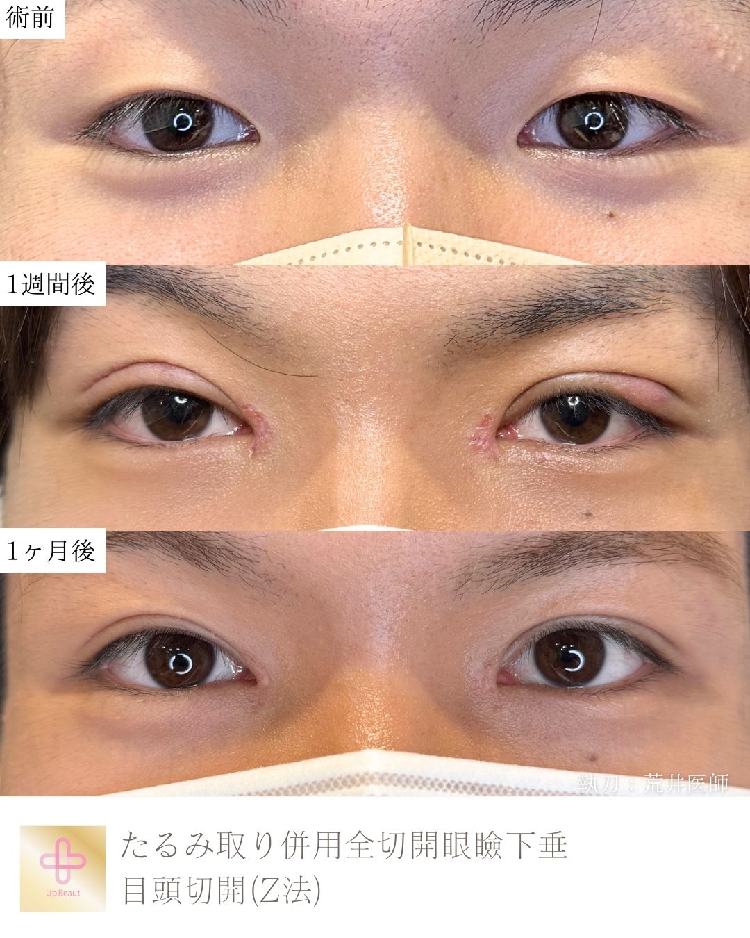 たるみ取り併用全切開二重術、目頭切開(Z法)