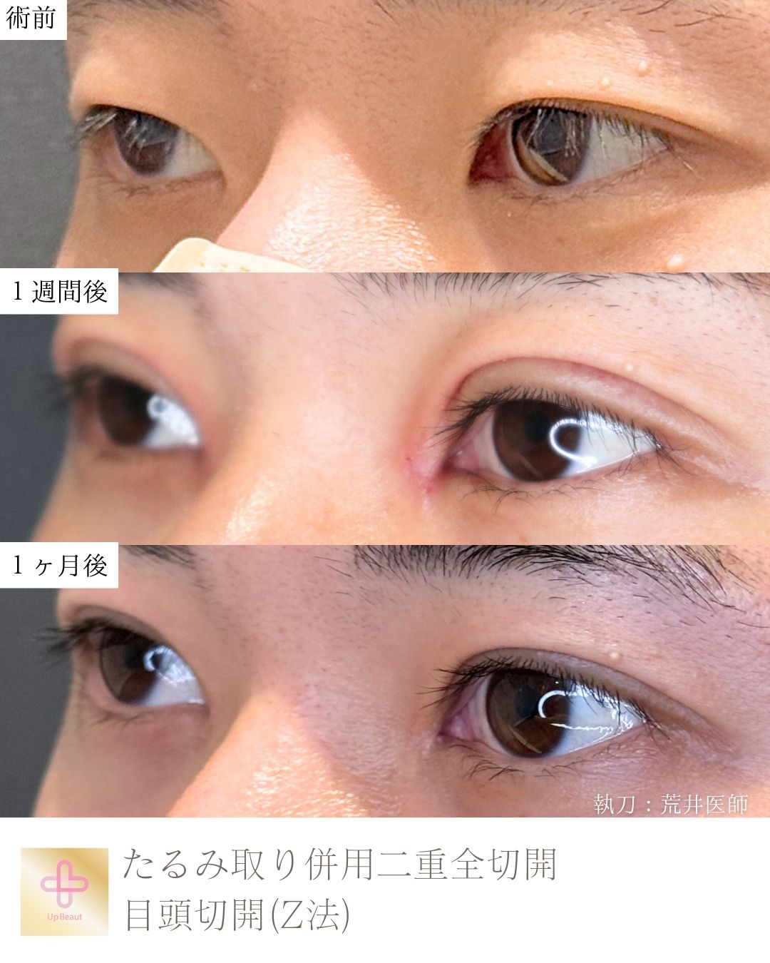 たるみ取り併用全切開二重術、目頭切開(Z法)