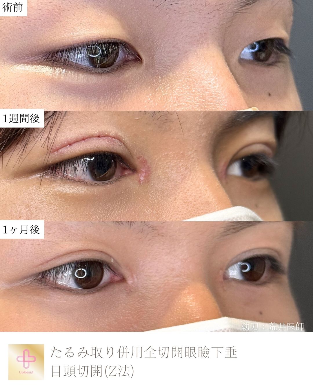 たるみ取り併用全切開二重術、目頭切開(Z法)