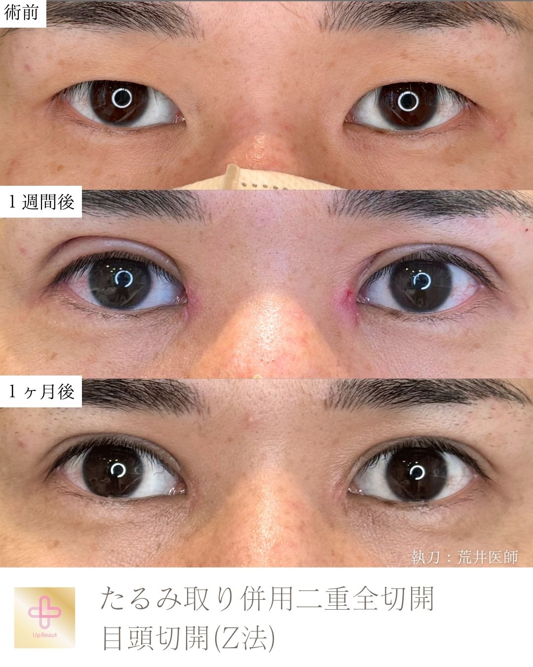 たるみ取り併用二重全切開、目頭切開 (Z法)
