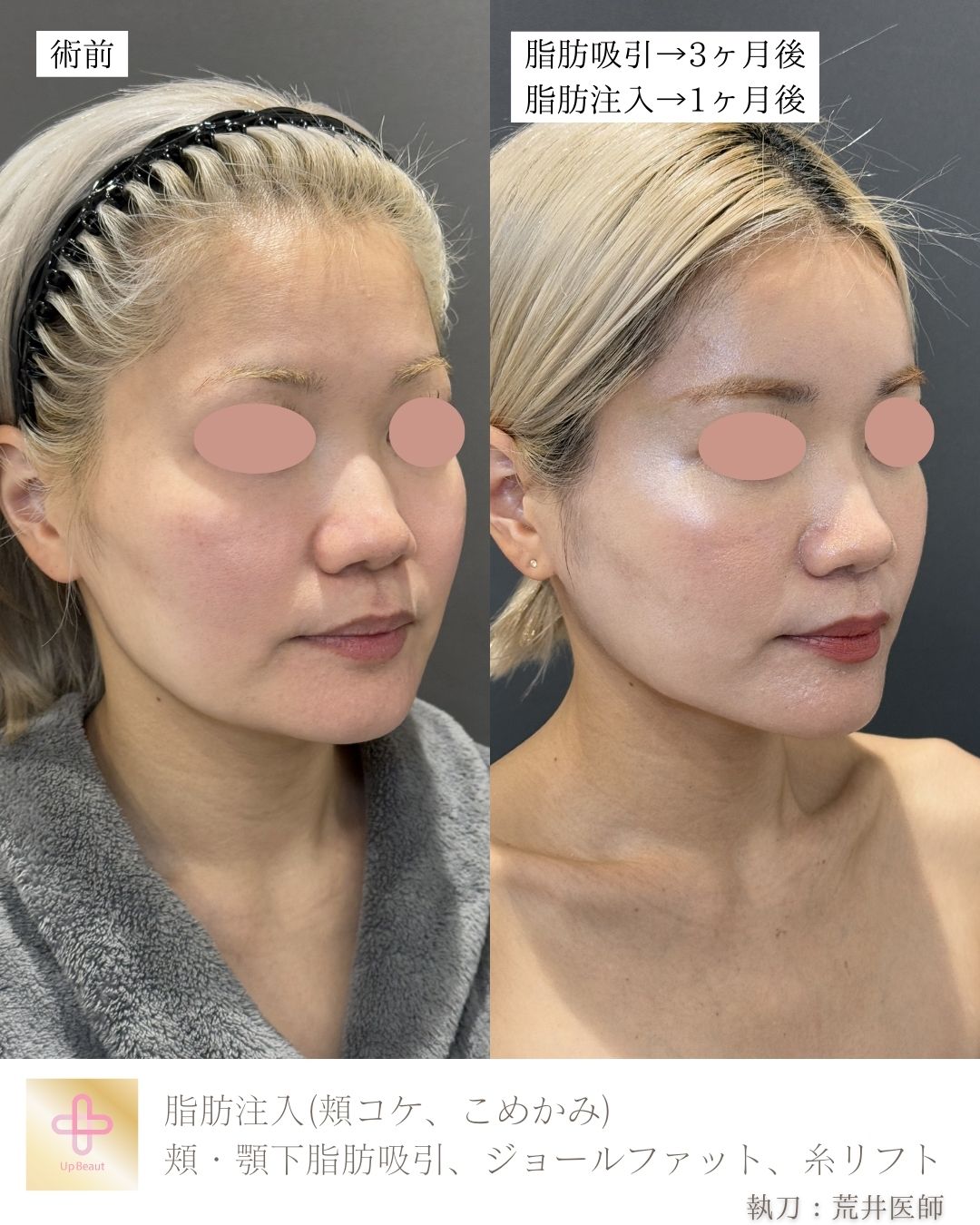 脂肪注入(頬コケ、こめかみ)、頬・顎下脂肪吸引、ジョールファット、糸リフト