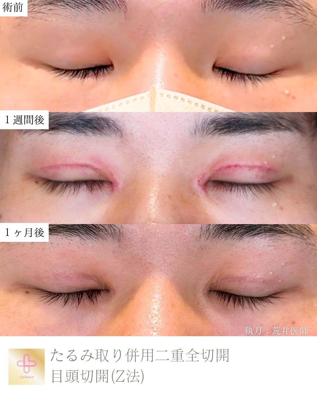 たるみ取り併用全切開二重術、目頭切開(Z法)