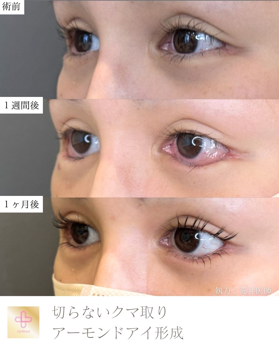 アーモンドアイ形成、切らないクマ取り