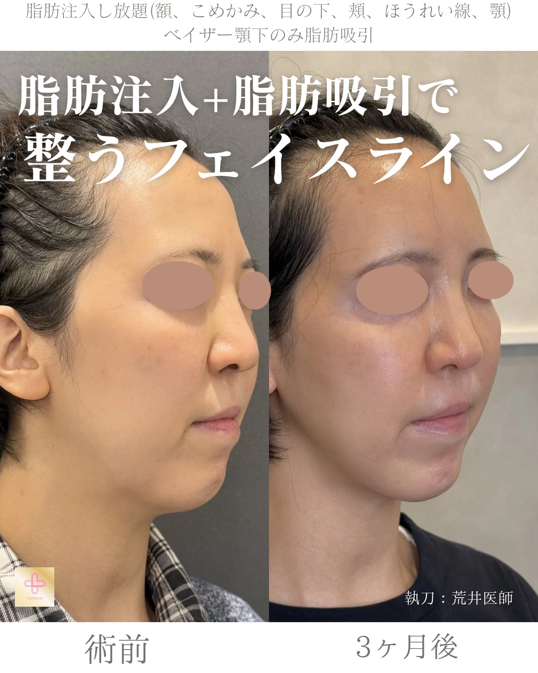 脂肪注入し放題、顎下脂肪吸引