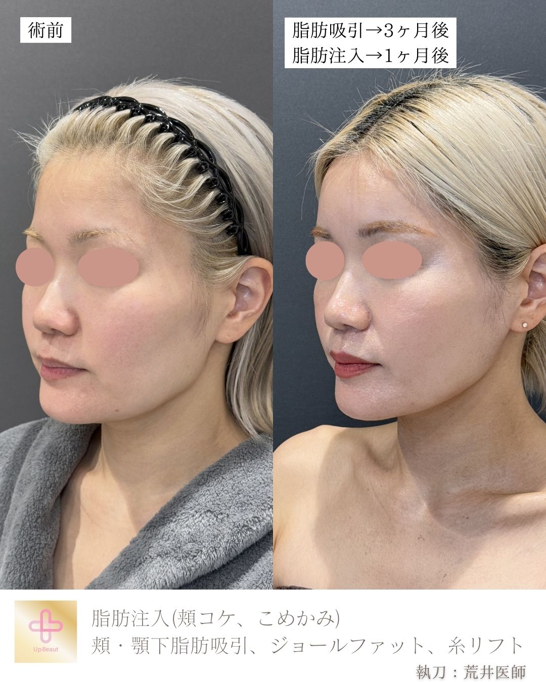 脂肪注入(頬コケ、こめかみ)、頬・顎下脂肪吸引、ジョールファット、糸リフト