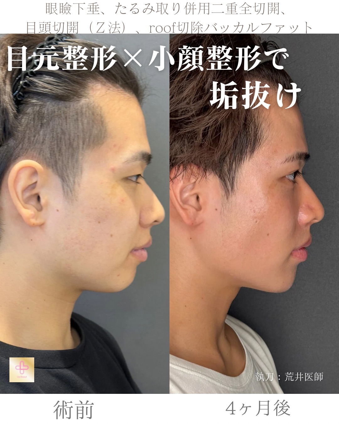 二重全切開たるみ取り併用、ROOF切除、眼瞼下垂、目頭切開(Z法)、バッカルファット、顎ヒアルロン酸1cc