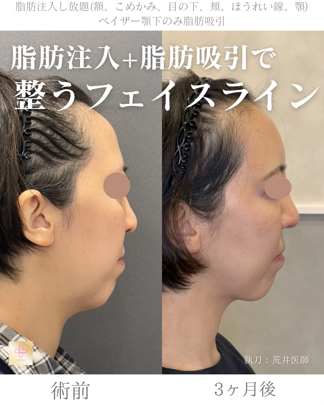 脂肪注入し放題、顎下脂肪吸引