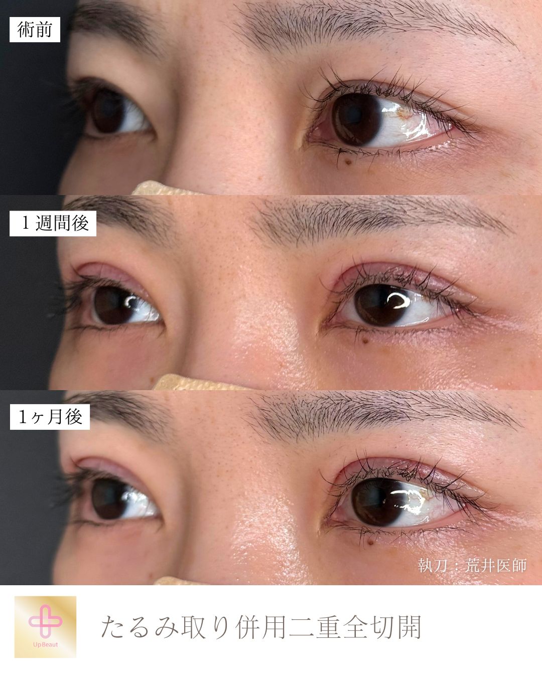 たるみ取り併用全切開二重術