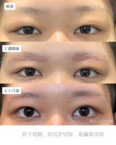 眉下切開症例