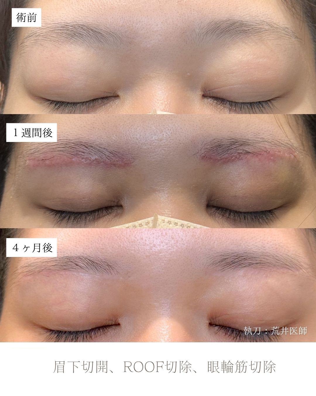 眉下切開症例