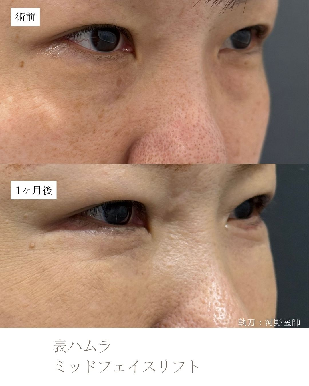 表ハムラ　ミッドフェイスリフト