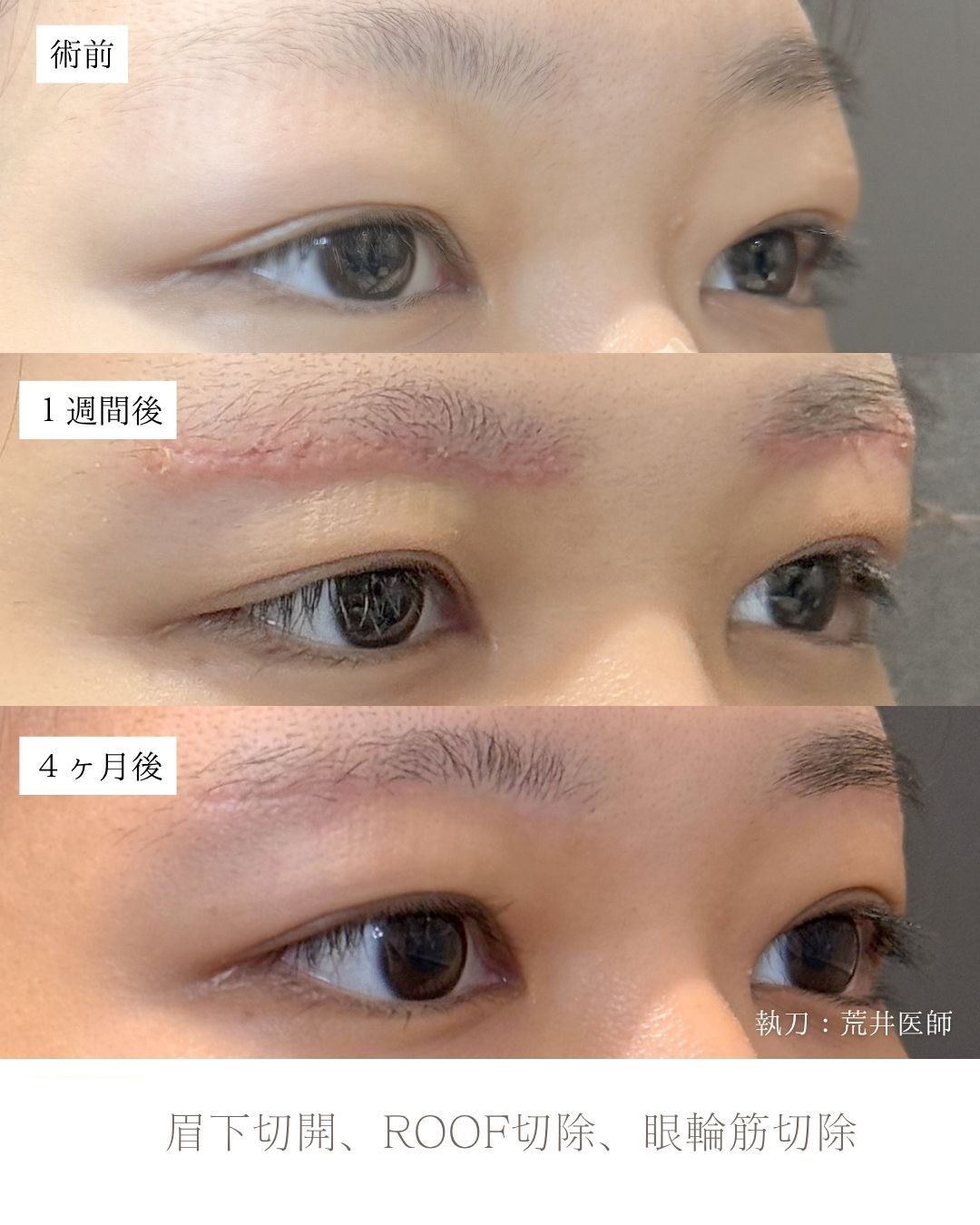 眉下切開症例