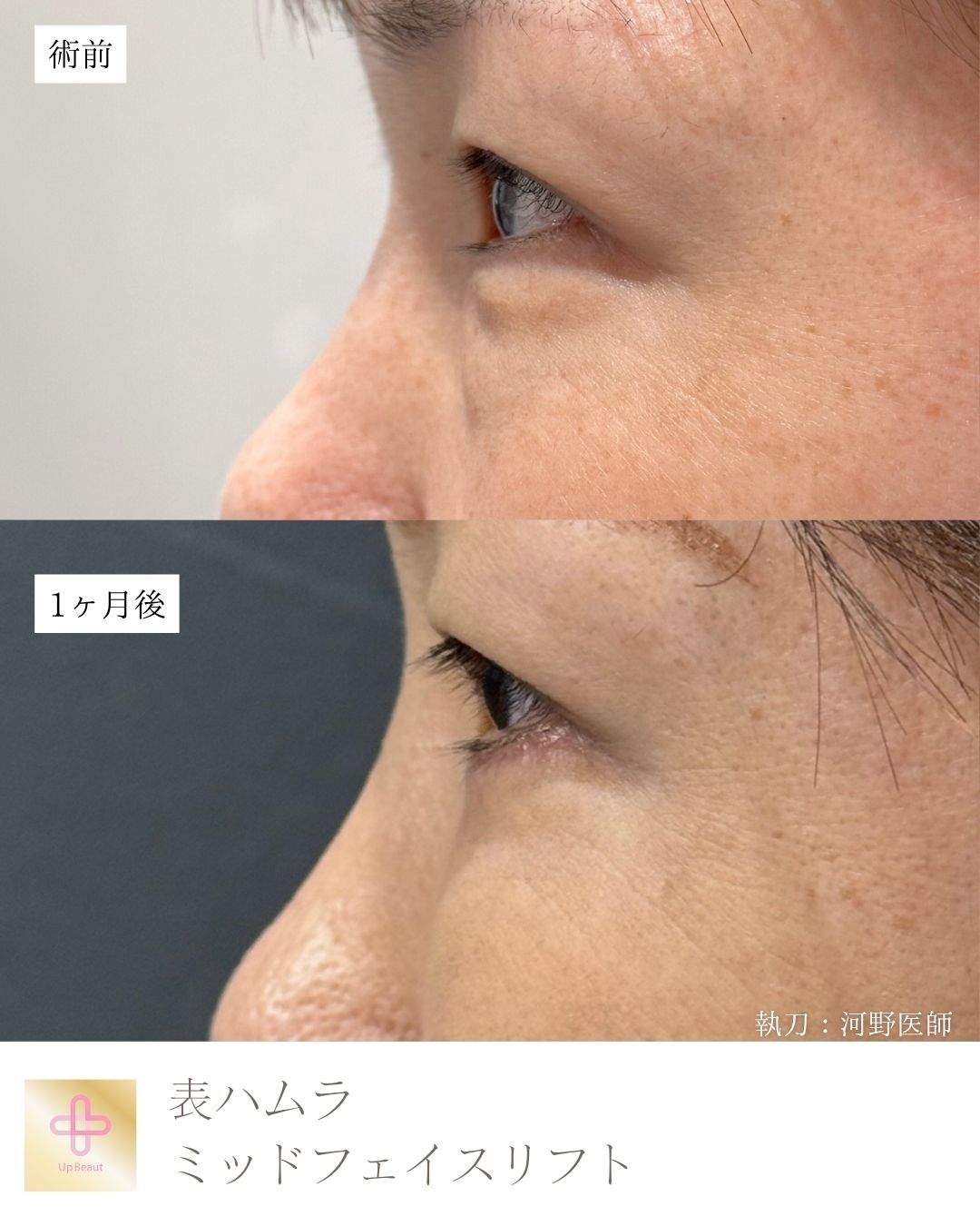 表ハムラ法 ・ミッドフェイスリフト