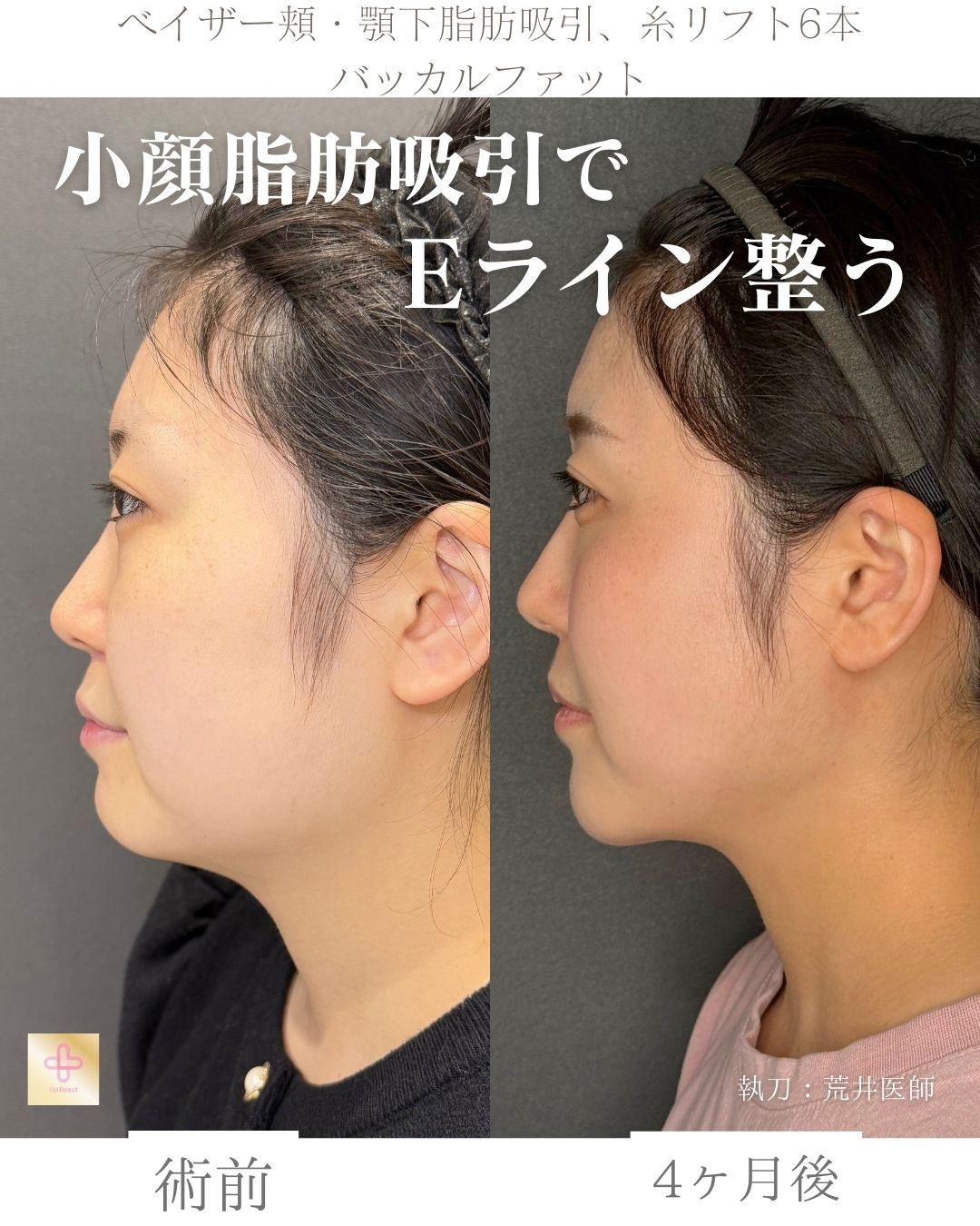 小顔脂肪吸引、バッカルファット、糸リフト