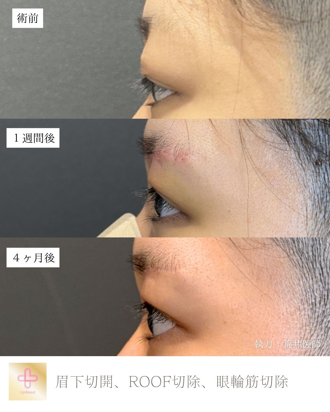 眉下切開、ROOF切除、眼輪筋切除