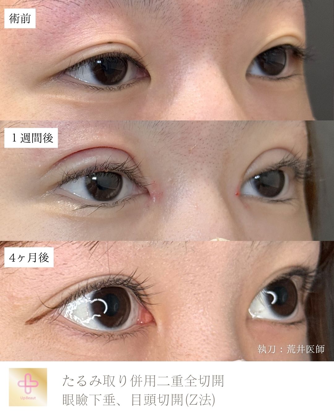 たるみ取り併用全切開二重術、目頭切開(Z法) 、眼瞼下垂