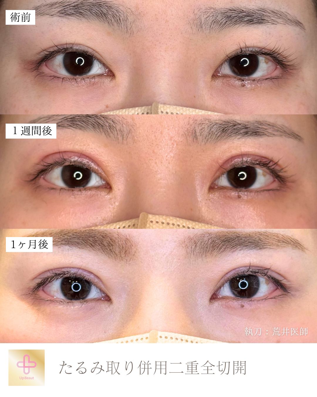 たるみ取り併用全切開二重術