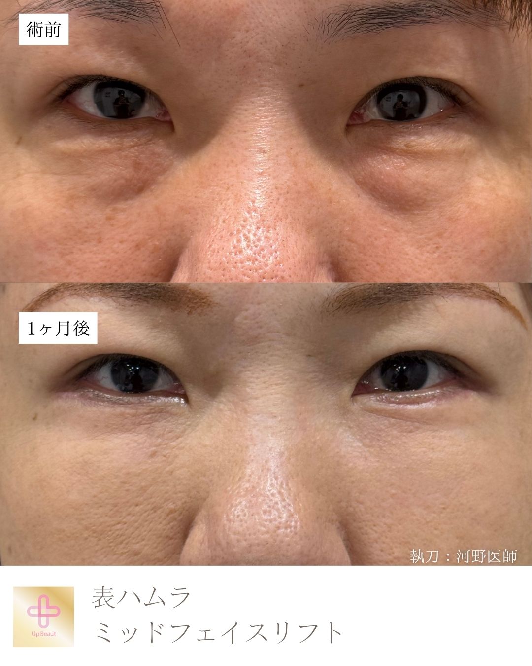 表ハムラ法 ・ミッドフェイスリフト