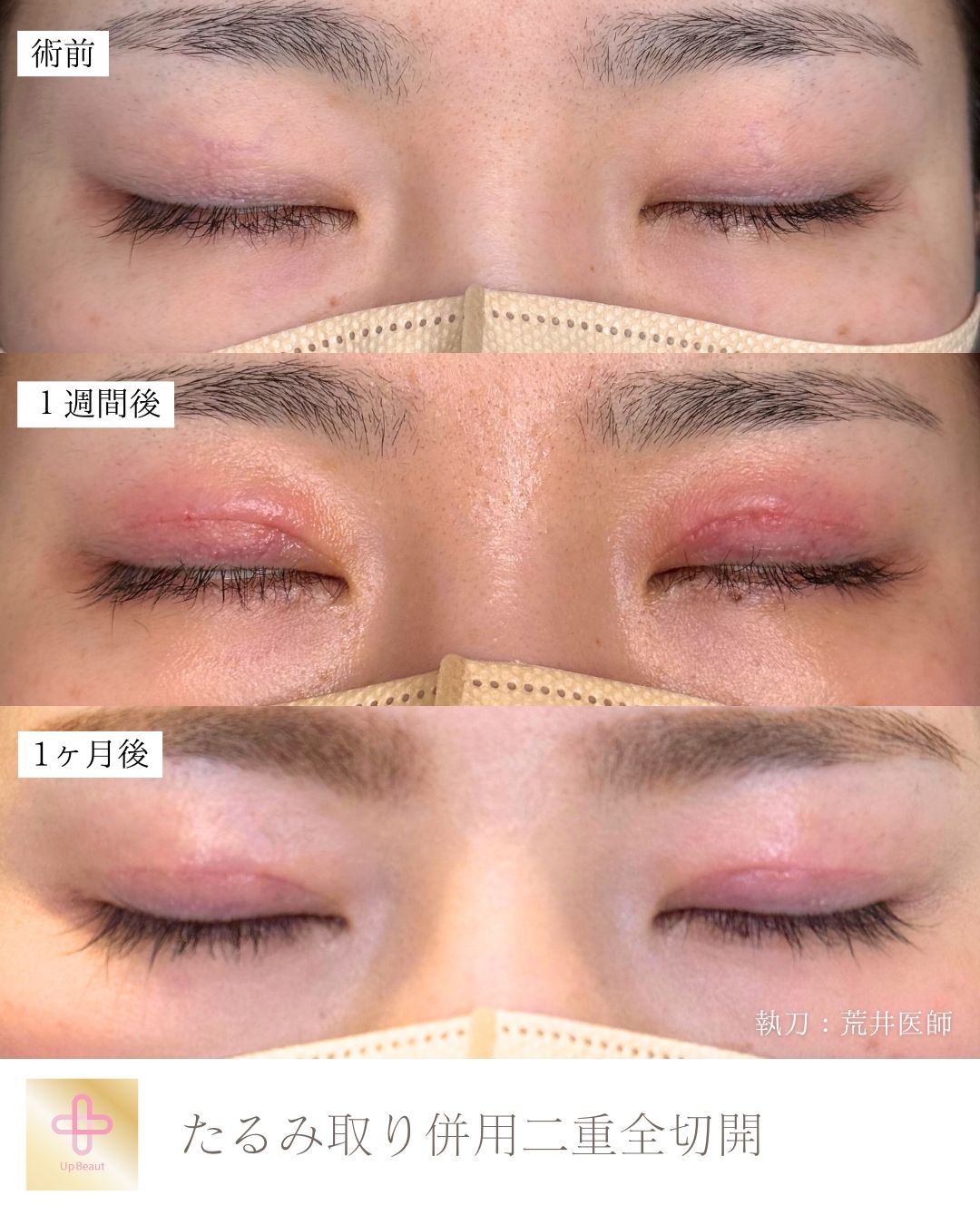 たるみ取り併用全切開二重術