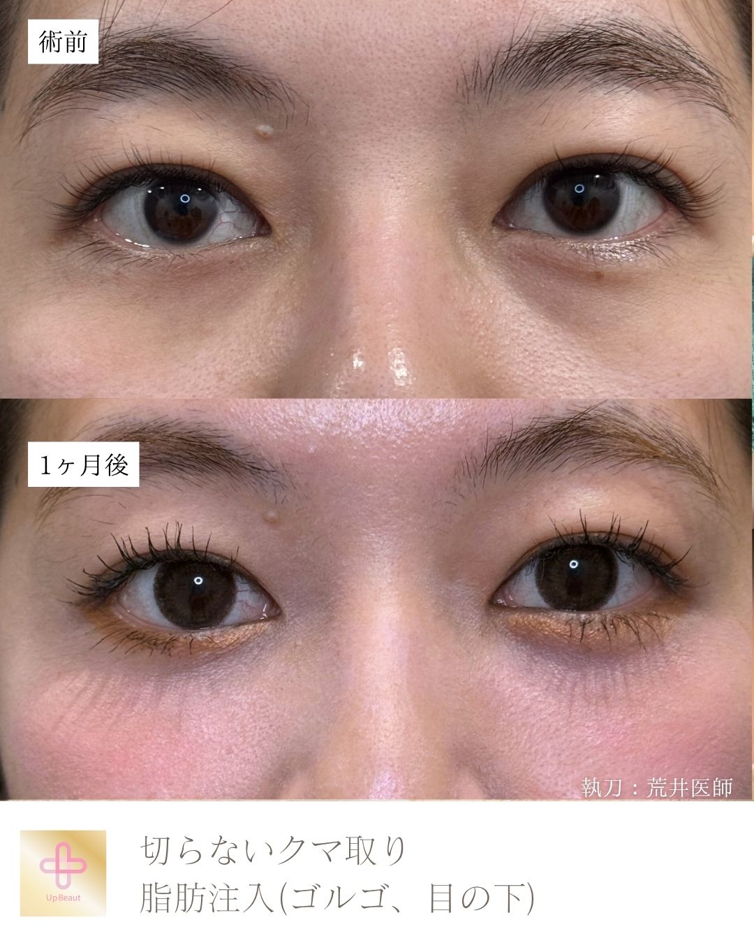 目の下の脱脂、脂肪注入（目の下）