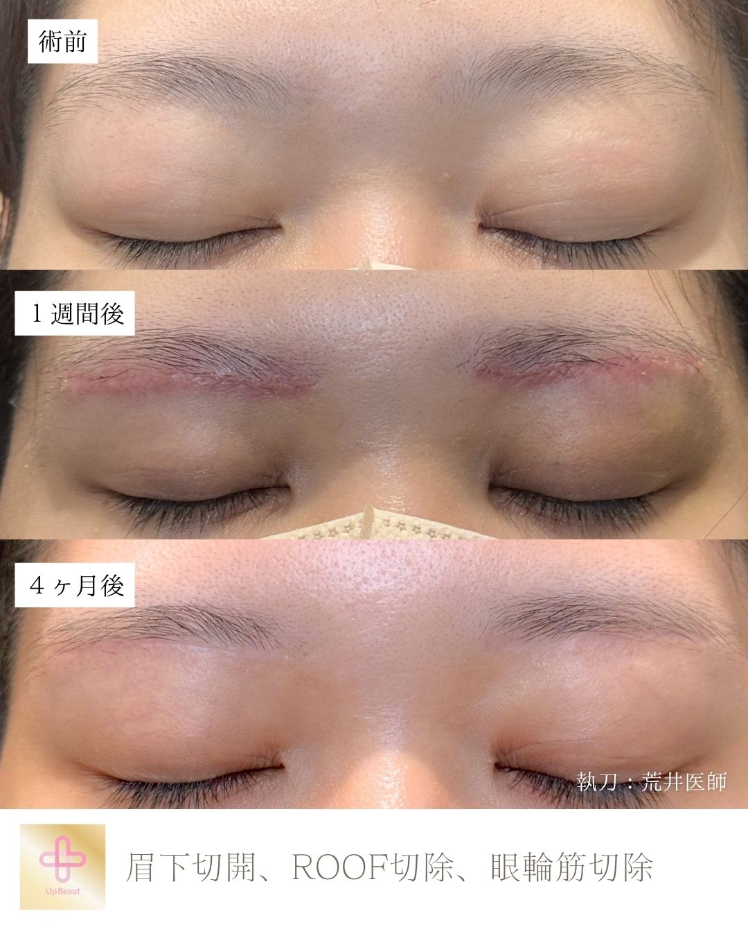 眉下切開、ROOF切除、眼輪筋切除
